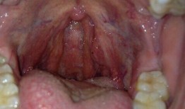 吃瓜之后感觉喉咙,揭秘喉咙不适的奥秘